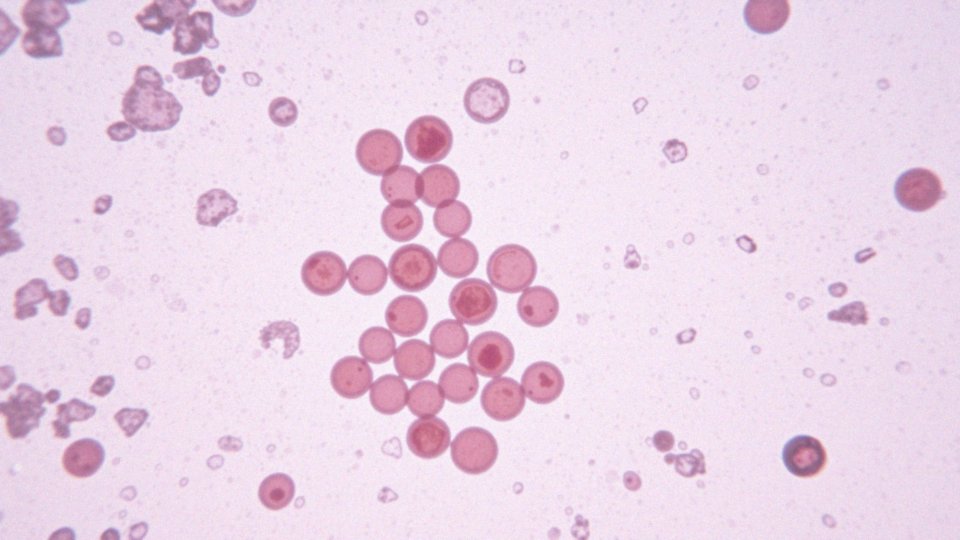 Liczne erytrocyty w cytologii – co to oznacza dla zdrowia?